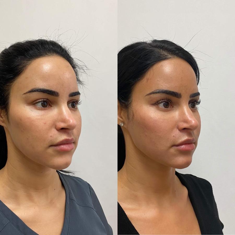 Click image for larger version

Name:	beauty-boost-threadlift-treatments-before-after-carousel-thirtyseven.jpg
Views:	3
Size:	69.4 KB
ID:	140118